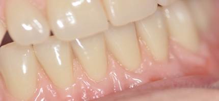 Quality complete dentures can offer amazing natural results from skilled practitioners